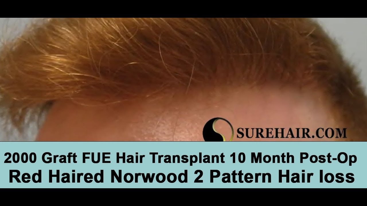 10 Month Post-OP 2000 Graft FUE Hair Transplant on Red Haired Norwood 2 Hair loss Pattern