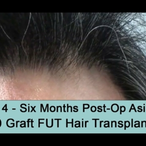 6 Months Post-Op Asian 55 Yr 3000 Graft FUT Hair Transplant