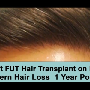 3000 Graft FUT Hair Transplant on Norwood 3 Hair Loss Pattern 1 Year Post-Op
