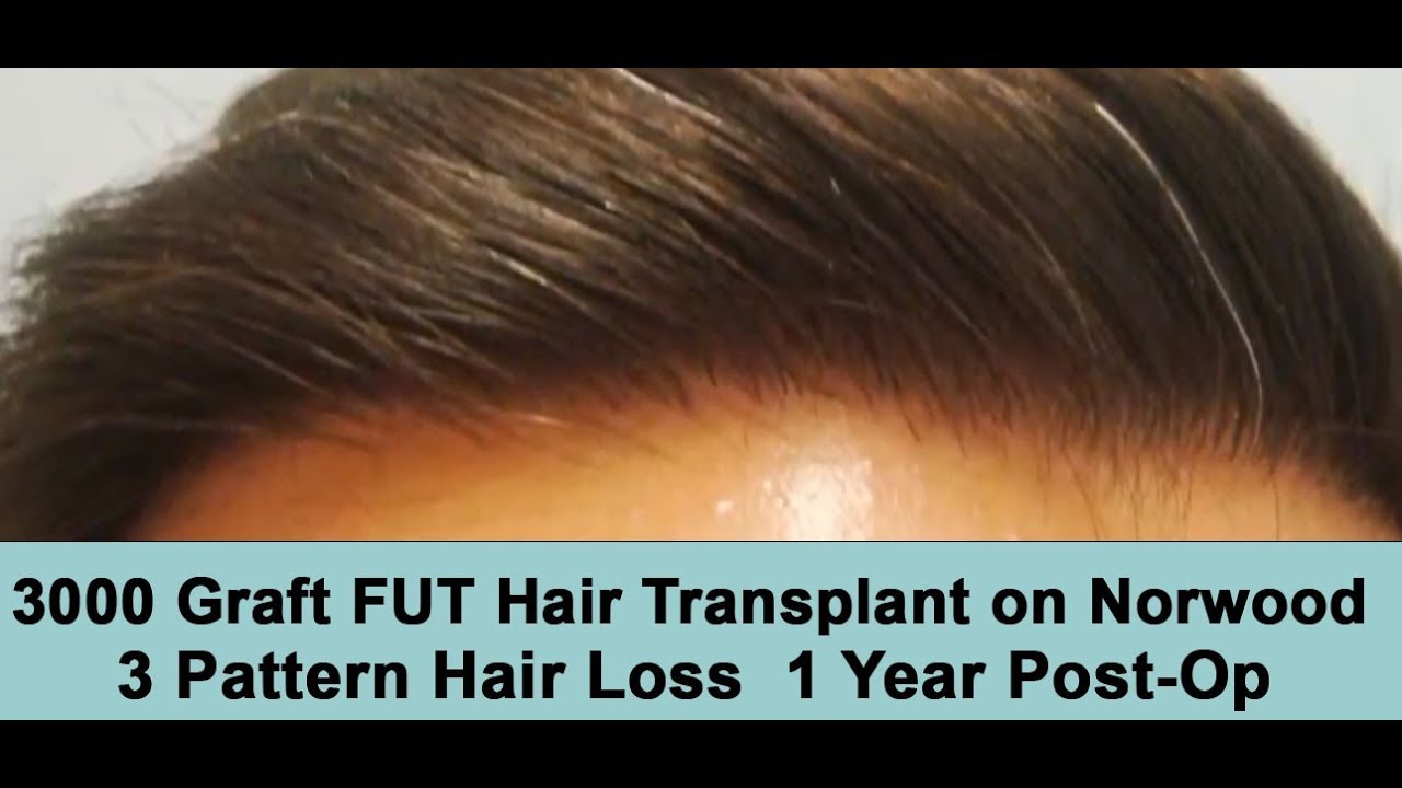 3000 Graft FUT Hair Transplant on Norwood 3 Hair Loss Pattern 1 Year Post-Op