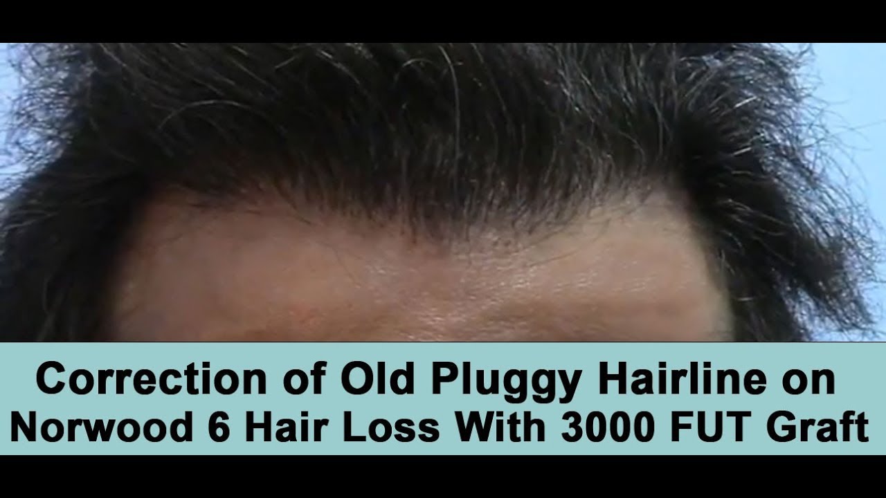 Correction of Old Hair Transplant on Norwood 6 Hair Loss Pattern