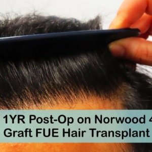 South Asian male FUE hair transplant 1 year post-op to fill in frontal area on Norwood 4 Pattern hair loss
