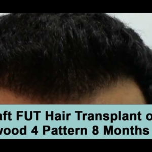 3000 Graft FUT Hair Transplant on Norwood 4 8 Months Post-Op
