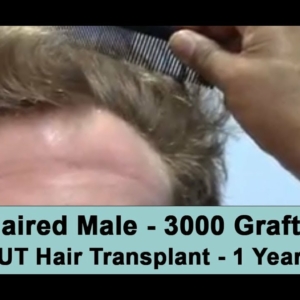 Norwood 3 Pattern On Red Hair White Male 33 year old 3000 Graft High Density FUT 1 Year Post-Op