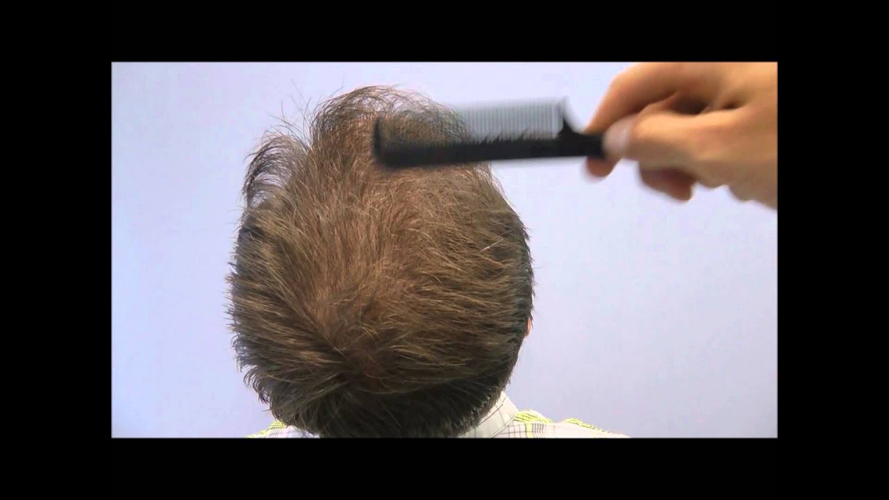 3000 Graft Crown FUT Hair Transplant | Toronto, Canada