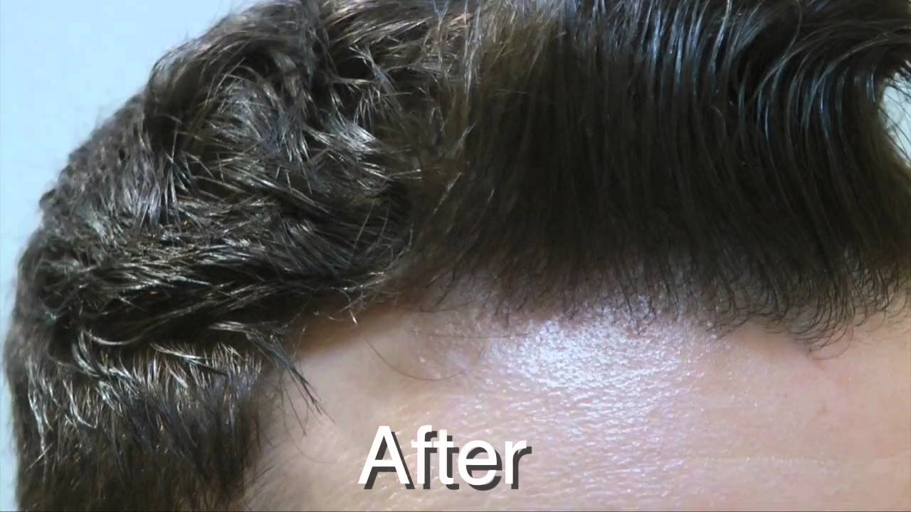 Norwood 3 - 3300 Graft FUT Hair Transplant