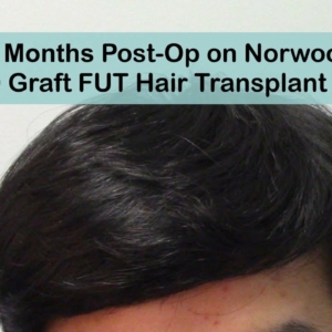 15 Months Post-Op Hair Transplant East Asian Norwood 4