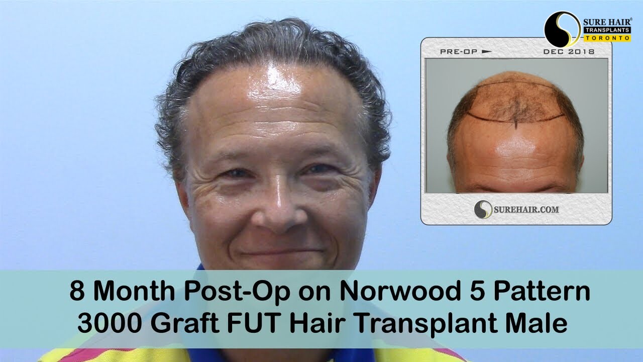 8 Month Post-OP FUT 3000 Grafts Hair Transplant - Norwood 5 Male