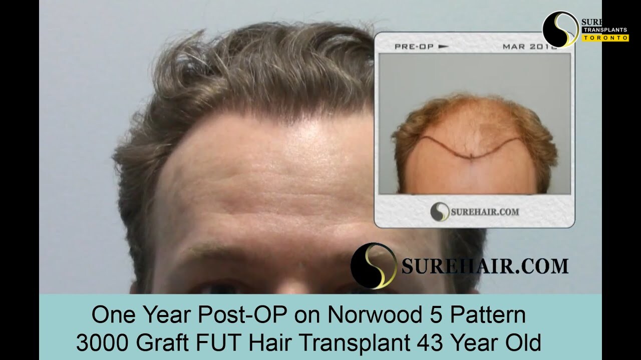 One Year Post-Op 3000 Graft FUT Hair Transplant on Norwood 5 Pattern