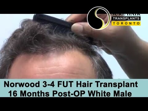 16 Months Post-Op FUT Hair Transplant