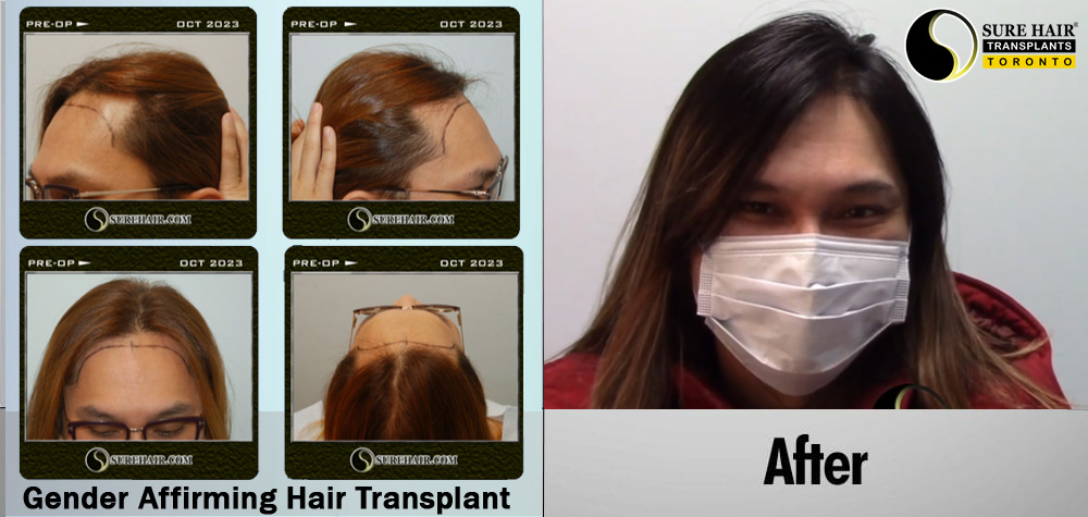 Gender affirming Hair Transplant