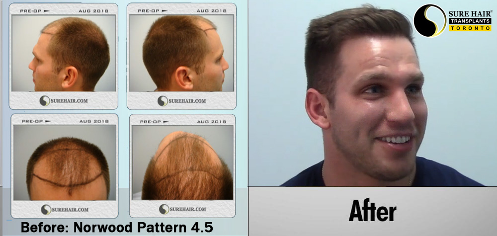 Norwood 4 FUE Hair Transplant Young Caucasian Male